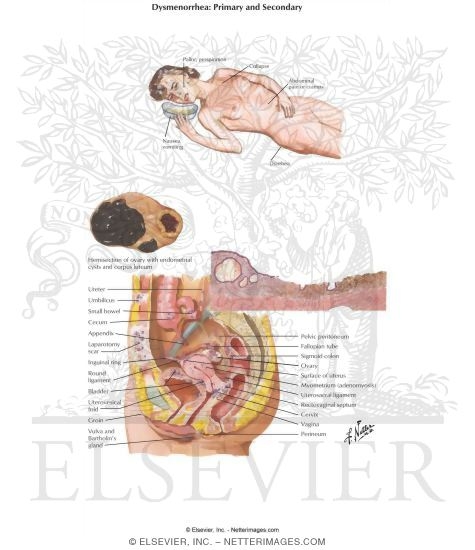 Dysmenorrhea: Primary and Secondary