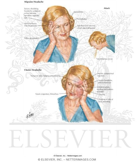 Watermarked preview of labeled image: Headache: Tension, Cluster and Migraine