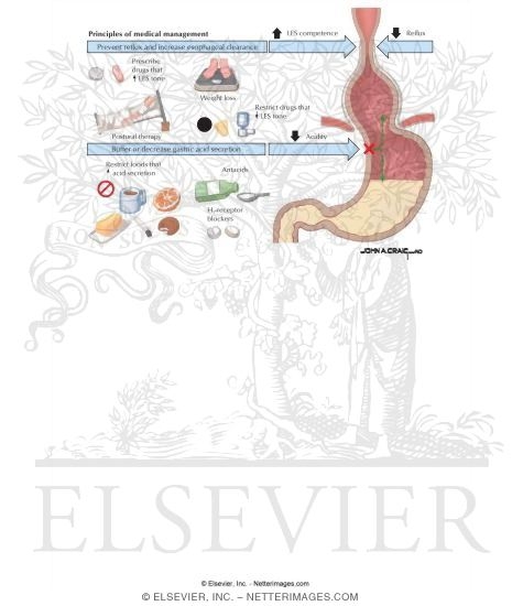 Watermarked preview of labeled image: Gastroesophageal Reflux