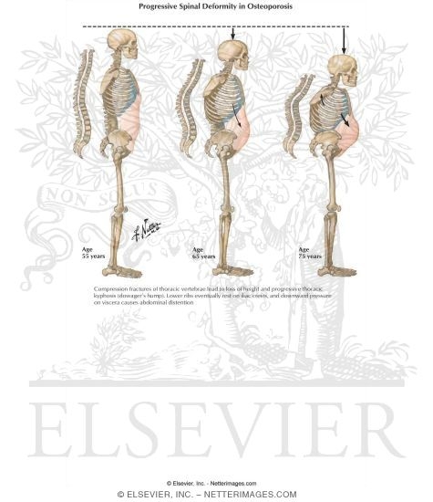 Watermarked preview of labeled image: Osteoporosis in Males