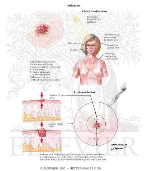 Watermarked preview of labeled image: Melanoma
