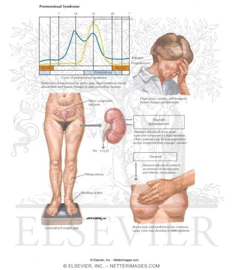 Watermarked preview of labeled image: Premenstrual Syndrome