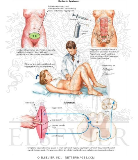 Watermarked preview of labeled image: Myofascial Syndromes