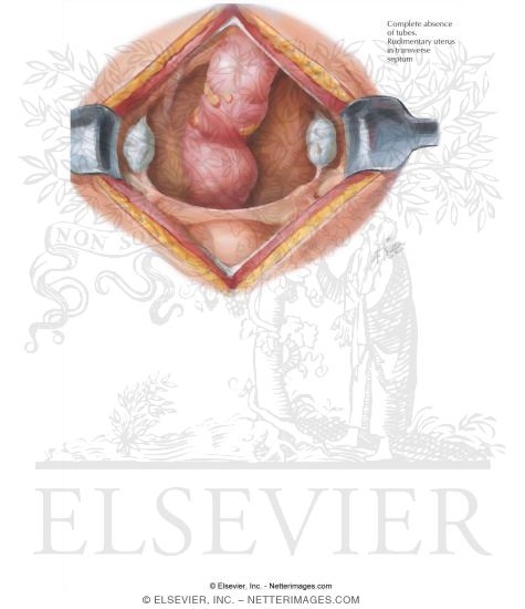 Watermarked preview of labeled image: Uterine Anomalies: Uterine Agenesis
