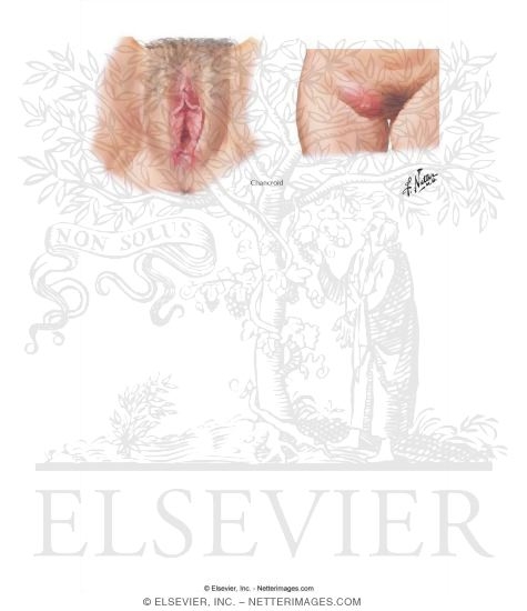 Watermarked preview of labeled image: Sexually Transmitted Infections: Chancroid