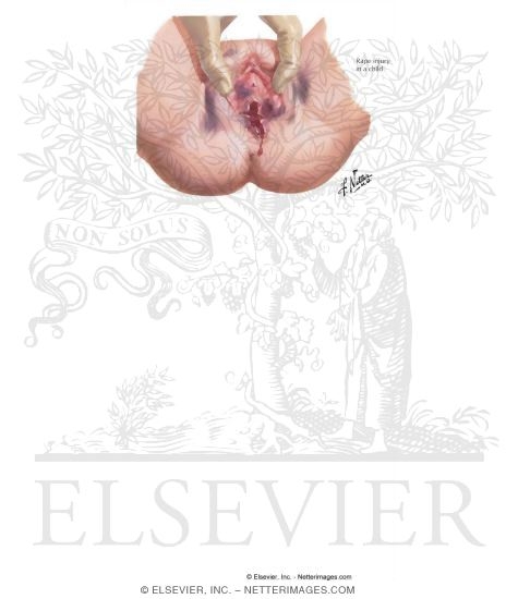 Watermarked preview of labeled image: Rape and Rape Trauma Syndrome