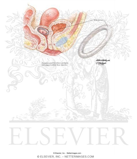 Watermarked preview of unlabeled image: Pessary Therapy