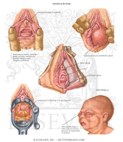 Gonorrhea in the Female