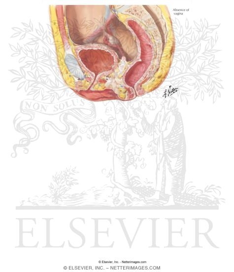 Watermarked preview of labeled image: Vaginal Agenesis