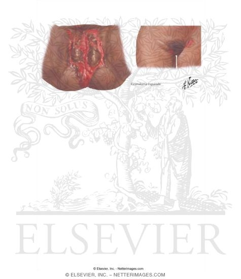 Watermarked preview of labeled image: Sexually Transmitted Infections: Granuloma Inguinale