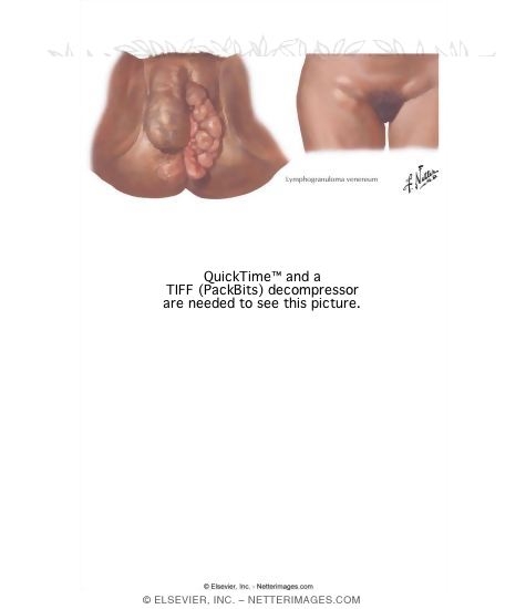 Sexually Transmitted Infections: Lymphogranuloma Venereum
