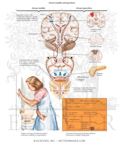 Detrusor Instability and Hyperreflexia
Anthroscopic Treatments
Urinary Incontinence: Bypass, Overflow, Stress, and Urge
