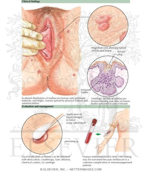 STD-Molluscum Contagiosum
Sexually Transmitted Infections: Molluscum Contagiosum