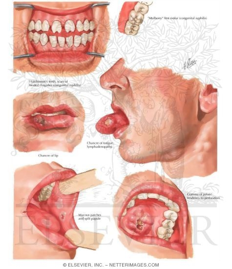 Congenital syphilis: A guide to diagnosis and management