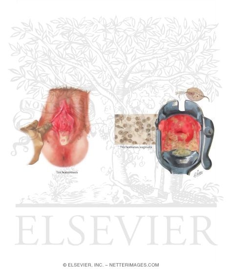 Watermarked preview of labeled image: Sexually Transmitted Infections: Trichomanas Vaginalis