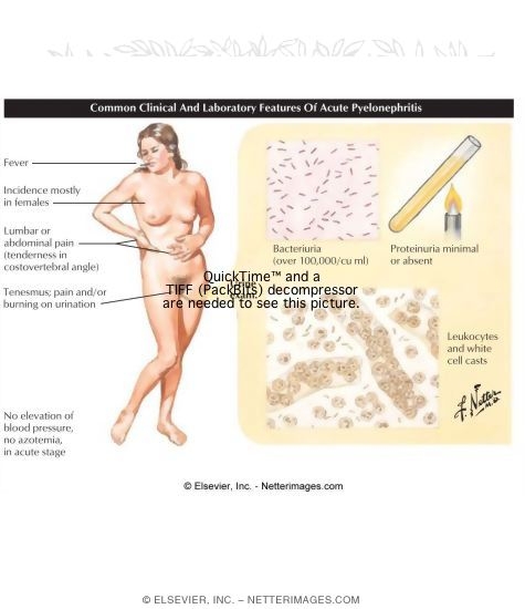 Urinary Tract Infection
Common Clinical and Laboratory Features of Acute Pyelonephritis