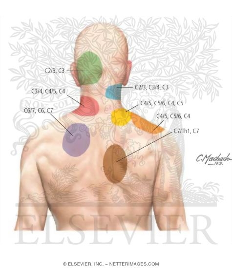 Watermarked preview of labeled image: Cervical Zygapophyseal Pain Syndromes