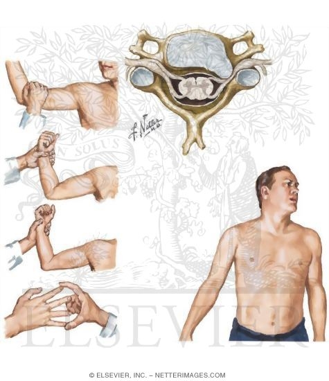 Cervical Radiculopathy