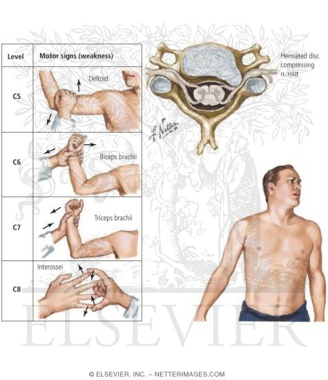 Watermarked preview of labeled image: Cervical Radiculopathy