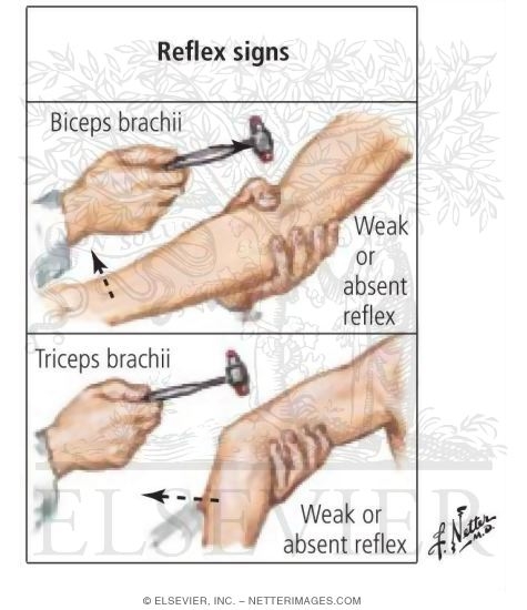 Cervical Radiculopathy: Muscle Stretch Reflexes