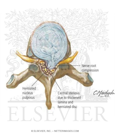 Watermarked preview of labeled image: Cervical Cord Compression