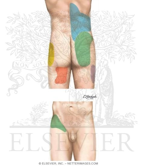 Watermarked preview of unlabeled image: Lumbar Zygapophyseal Joint Pain Referral Patterns