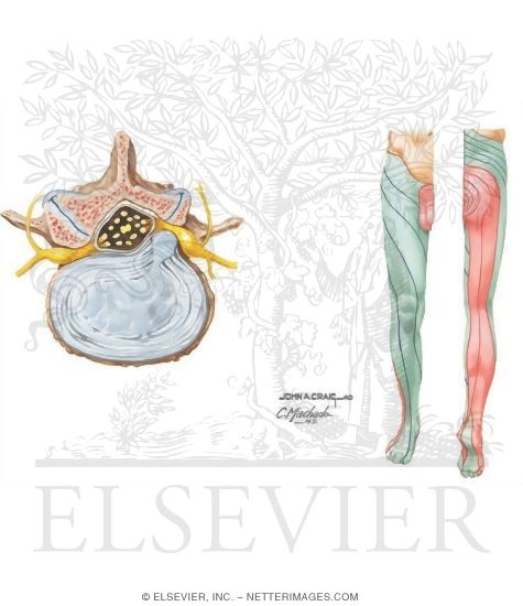 Watermarked preview of unlabeled image: Lumbosacral Radiculopathy: Physical Examination