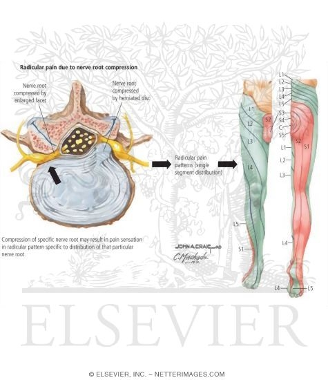 Watermarked preview of labeled image: Lumbosacral Radiculopathy: Physical Examination