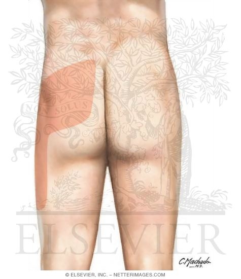 Sacroiliac Joint Pain Referral Patterns
