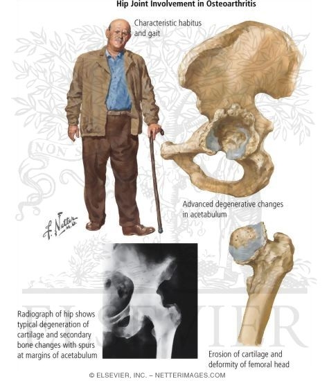Hip Joint Involvement in Osteoarthritis