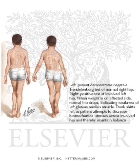 Detecting Osteoarthritis of the Hip: The Cyriax Capsular Pattern