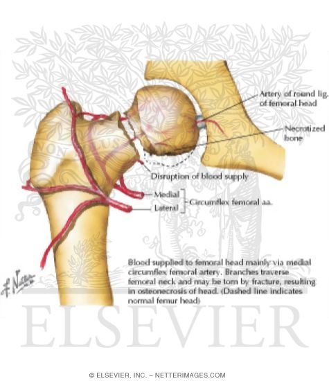 Watermarked preview of labeled image: Osteonecrosis After Fracture