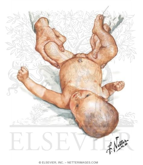 Watermarked preview of unlabeled image: Detecting Developmental Dysplasia of the Hip In Infants: Limited Hip