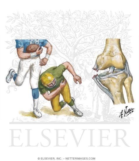 Watermarked preview of unlabeled image: Detecting Tibial Collateral Ligament Ruptures