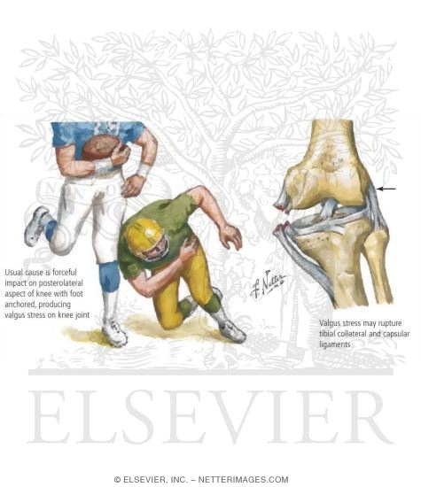 Watermarked preview of labeled image: Detecting Tibial Collateral Ligament Ruptures