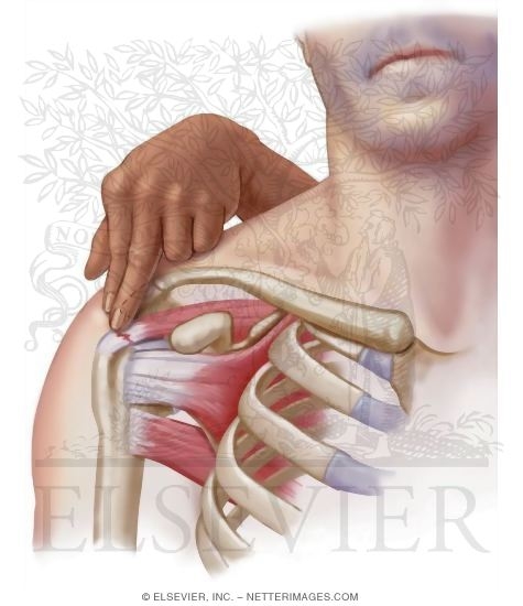 Watermarked preview of unlabeled image: Rotator Cuff Tears (Unspecified Muscles)