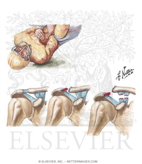 Watermarked preview of unlabeled image: Detecting Acromioclavicular Lesions