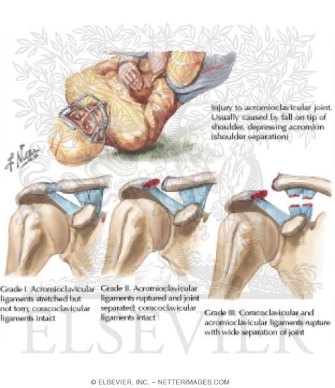Watermarked preview of labeled image: Detecting Acromioclavicular Lesions