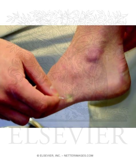 Pin-Prick Test