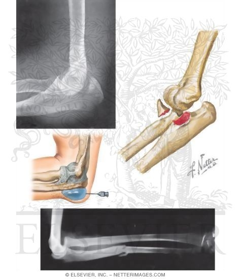 Conditions of the Elbow: Proximal Ulna and Olecranon