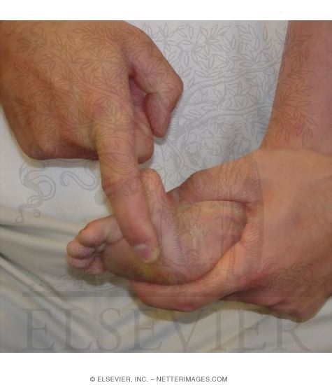 Watermarked preview of unlabeled image: Accuracy of the Functional Hallux Limitus Test to Predict Abnormal Excessive Midtarsal Function During Gait