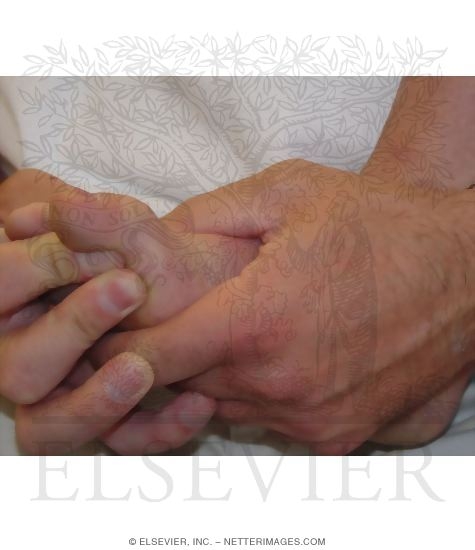 Detecting Plantar Fasciitis: Windlass Test, Non-Weight Bearing