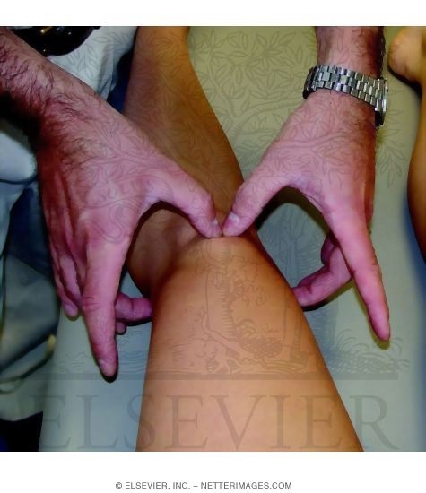 Watermarked preview of unlabeled image: Examination of Mediolateral Patellar Orientation