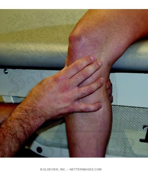 Palpation of Medial Joint Line In Patients With Osteoarthritis of Knee