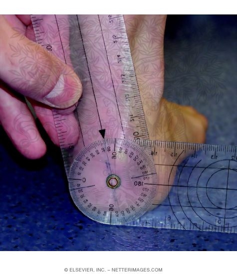 Watermarked preview of unlabeled image: Measurements of Relaxed Calcaneal Stance Position