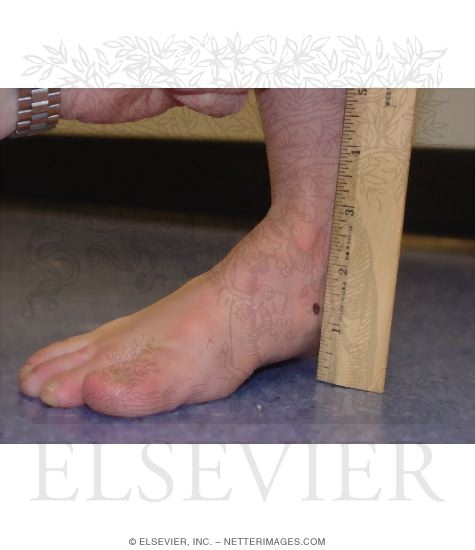 Measurement of Navicular Height