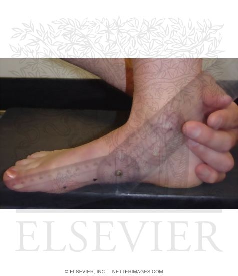 Watermarked preview of unlabeled image: Assessment of Medial Arch Height: Measurement of Arch Angle
