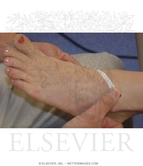 Measuring Ankle Joint Swelling: Start of Figure-of-Eight Measurement
