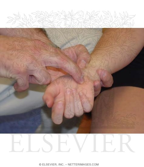 Carpal Tunnel Syndrome: Tinel Sign