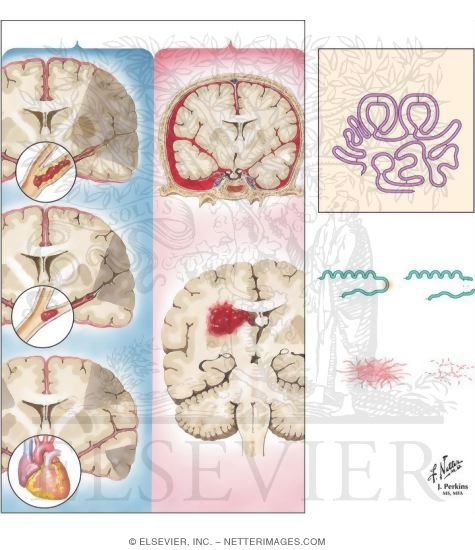 Watermarked preview of unlabeled image: Stroke: Symptoms and Drug Treatmtent
